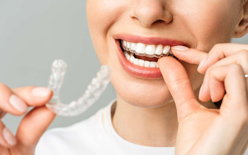 Invisalign for straighter teeth