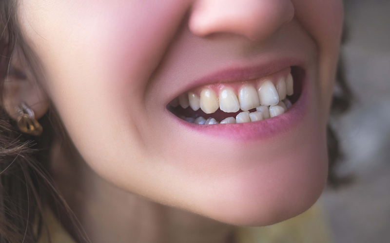 What causes a crooked smile