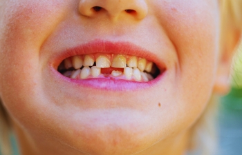 Can Half-Broken Teeth Be Fixed?