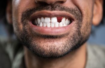 what happens if you do not replace a missing tooth