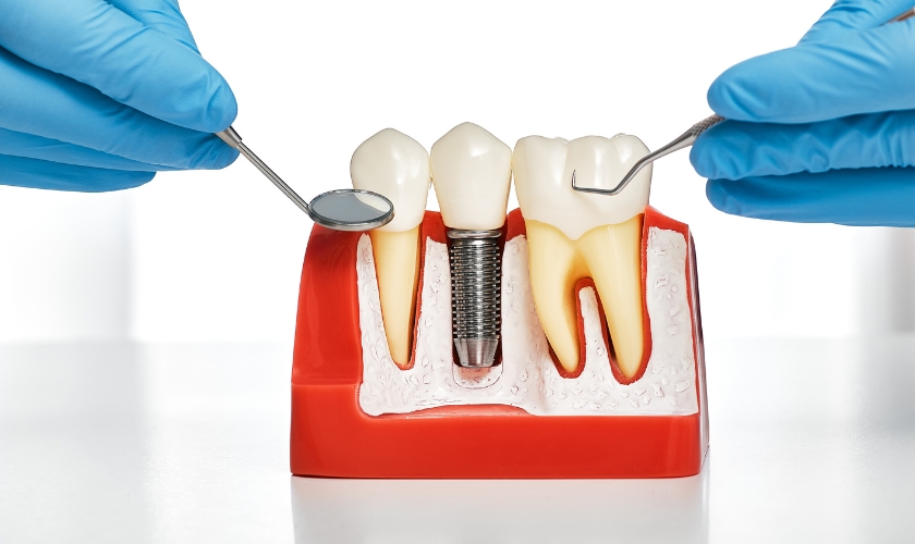 dental implants in Highlands Ranch