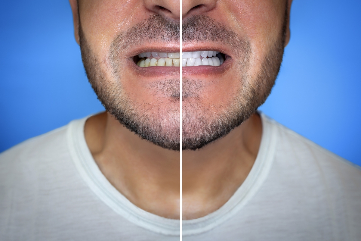 teeth whitening treatment | Restore Dental Highlands Ranch