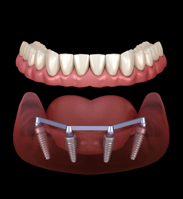 Full arch dental implant restoration before and after result