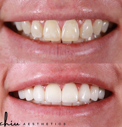 Before and after teeth alignment results for an adult man