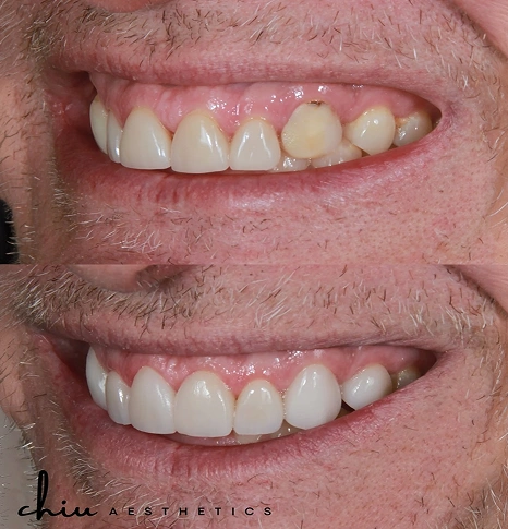 Before and after Invisalign smile transformation of an older man
