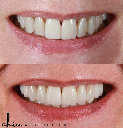 Before and after Invisalign smile transformation of a woman
